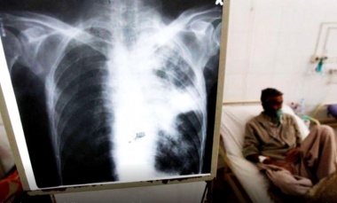 Tuberculosis: desde 2020 los casos aumentaron un 65%