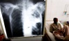 Tuberculosis: desde 2020 los casos aumentaron un 65%